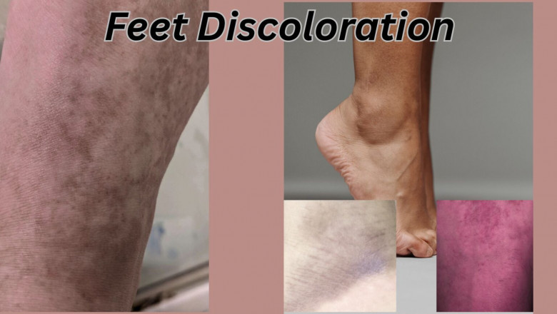 Feet Discoloration: Causes, Symptoms and Solutions
