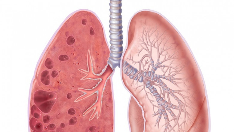 Global Emphysema Market Trends and Growth Strategies