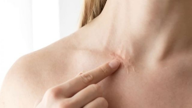 Hypertrophic Scar Market Size, Trends and Growth Strategies