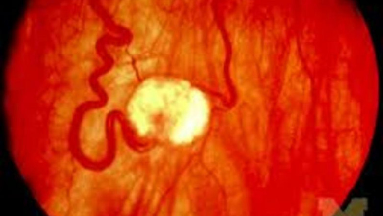 Key Insights on Von Hippel-Lindau Disease Market Growth