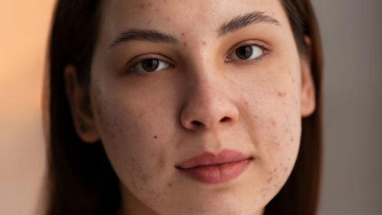 Tackle Common Skin Issues: Pimples, Face Spots, and Skin Tag