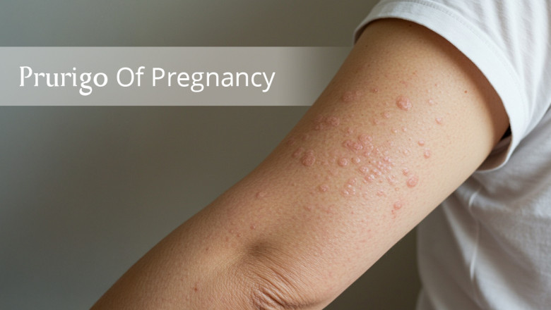 Understanding Prurigo Of Pregnancy: Causes, Risks &amp; Management – AreoVeda