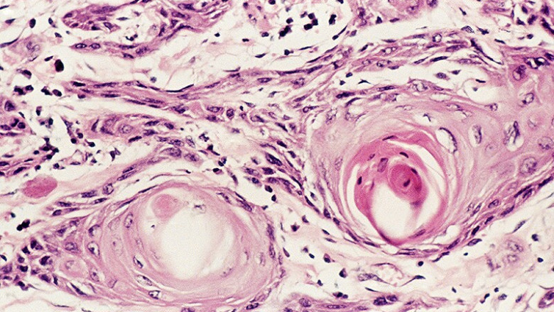 Advanced Non-Squamous and Squamous NSCLC Market Outlook 2025–2032