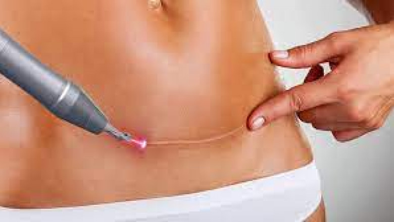 Can I Remove Burn Scars with Laser Treatment?