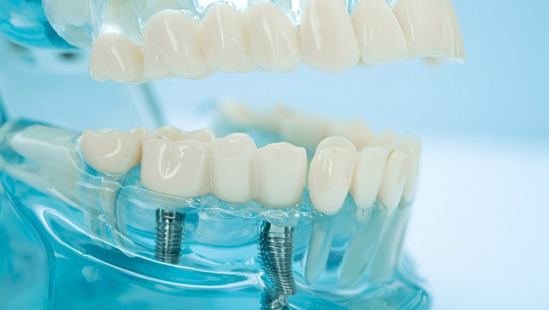 Discover the Life-Changing Benefits of Dental Implants in Burns Lake