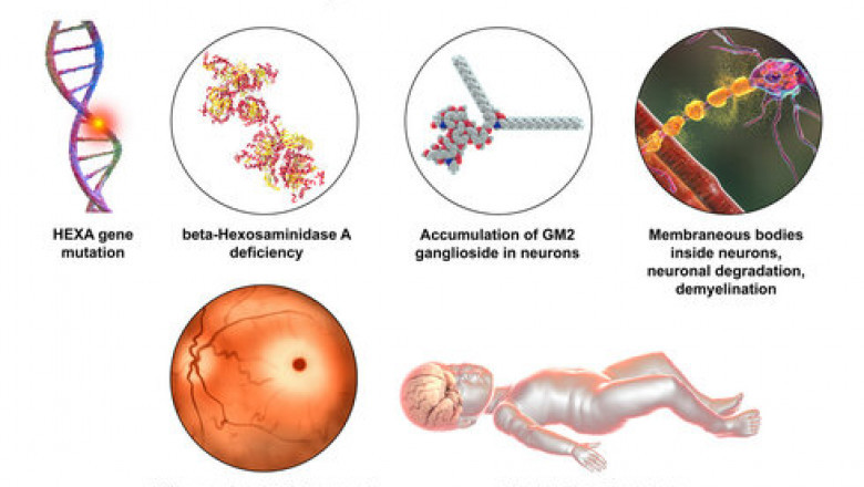 Driving Growth in Tay-Sachs Disease Treatment Market