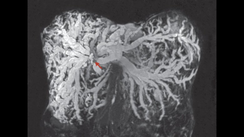 Intrahepatic Cholangiocarcinoma Market Size, Trends, and Growth Strategies
