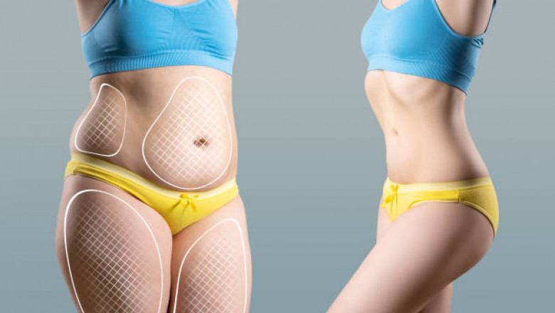 Liposuction in Riyadh: Modern Techniques for Lasting Results