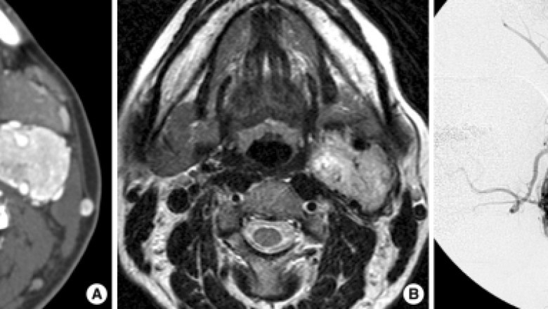 Paraganglioma Market Growth Driven by Therapeutic Advances