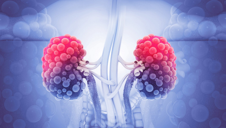 Autosomal Dominant Polycystic Kidney Disease Market Growth, Size, Industry Demand by 2025-2033