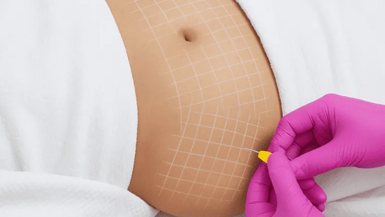 Body Goals, No Knife: The Truth About Fat-Dissolving Shots