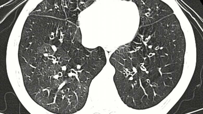 Bronchiolitis Obliterans Syndrome Treatment Market Growth, Analysis Report by 2025-2033