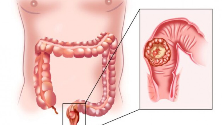 Global Anal Cancer Market Expands with Immunotherapy as Frontline Standard