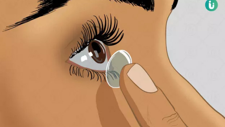 Global Therapeutic Contact Lenses Market Insights: Smart Lenses &amp; Biosensor Integration