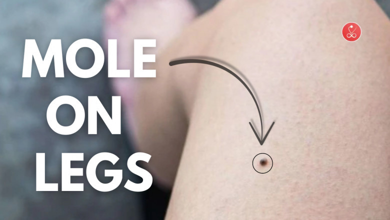 Mole on Legs - What It Really Means