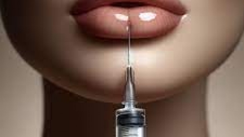 Are Lip Fillers Permanent or Temporary?