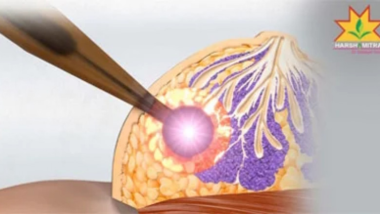 Comprehensive Breast Cancer Care at Harshamitra Hospital