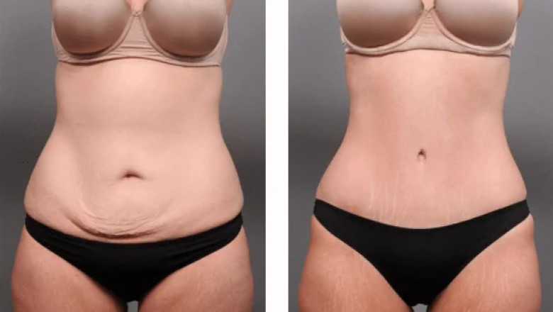Tummy Tuck Dubai: Cost, Packages, and Financing Options