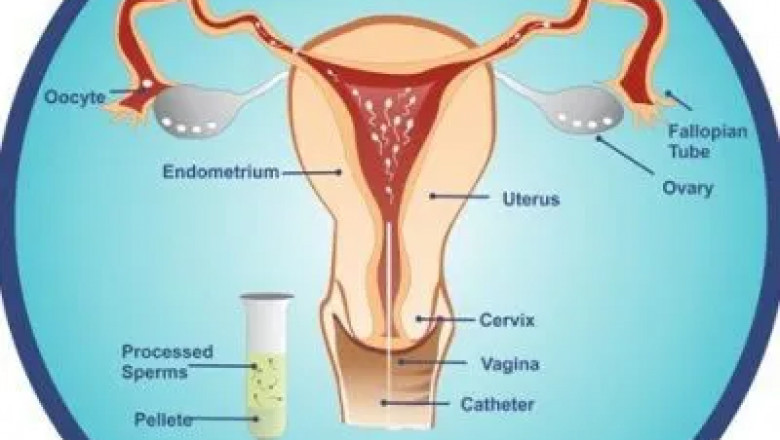 Best IUI Centre in Gachibowli | Hyderabad - Dr Sravya Buggana