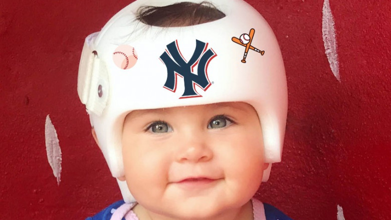 Custom Infant Helmet Therapy in New York for Head Shaping
