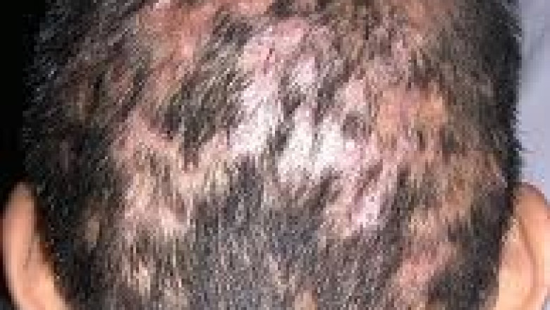 Global Alopecia Market Size, Share, Trends, and Forecast 2021–2030