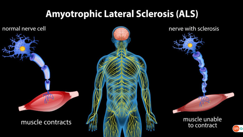 Global ALS Therapeutics Market Outlook: Growth, Innovations, and Forecast 2021 – 2030