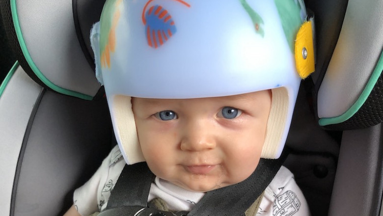 Plagiocephaly Treatment in New York | Expert Pediatric Care