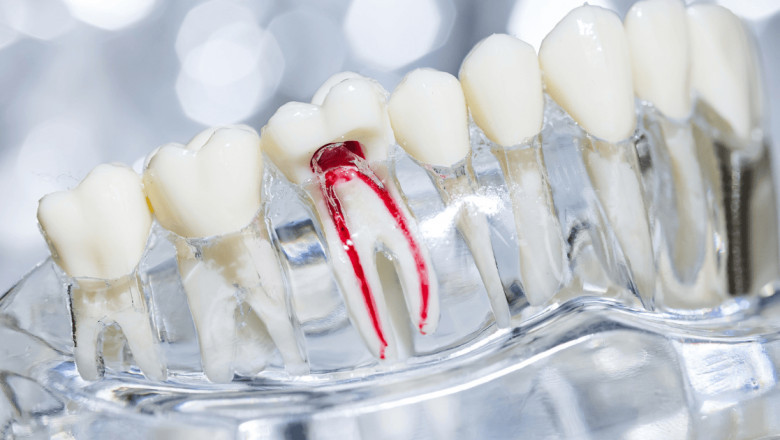 Root Canal Treatment in Lucknow: Everything You Need to Know