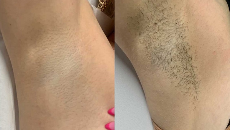 Say Goodbye to Shaving: Try Laser Hair Removal Today