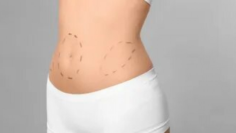 Tummy Tuck in Chicago for a Flat, Firm Midsection