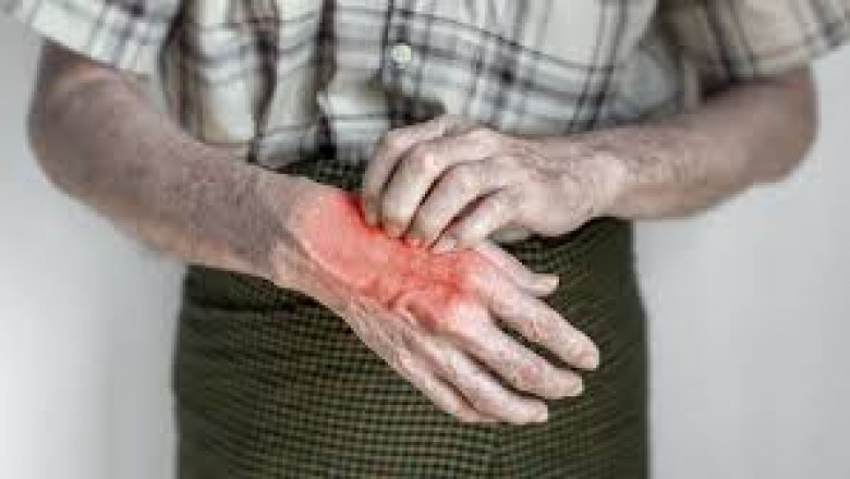 Bullous Pemphigoid Market Size, Trends, and Growth Analysis 2025-2032