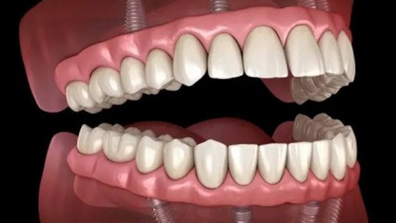 Eat Your Favorite Foods Again – Get Dental Implants Now