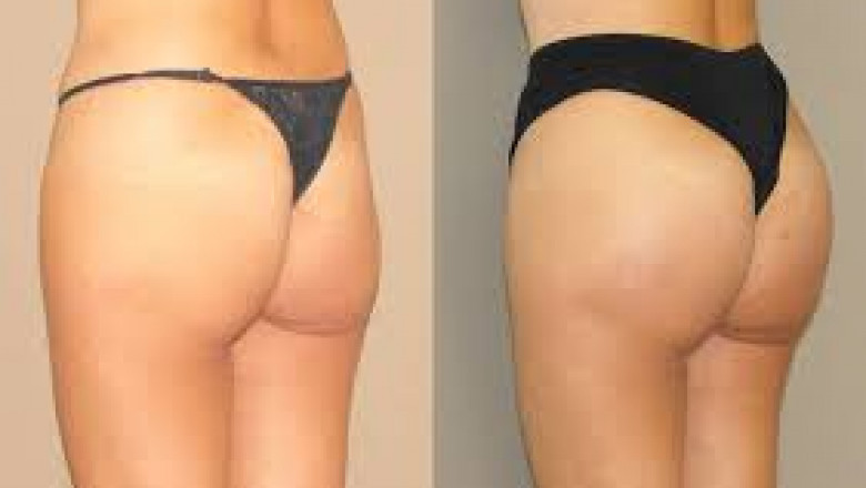 How Much Fat Is Needed for a Brazilian Butt Lift?