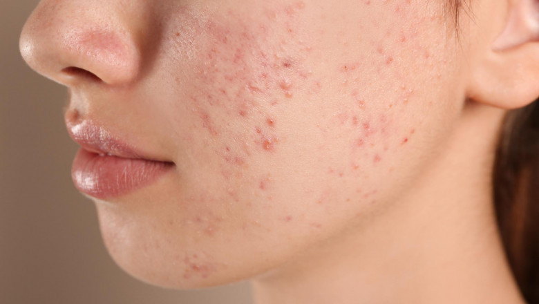 Tenage Acne vs. Adult Acne: What's the Difference?