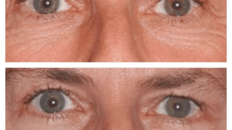 When should you consider Eye bag removal in Dubai?