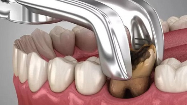 Your New Teeth Start Here – Explore Dental Implants