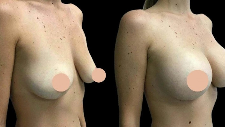 Breast Augmentation in Dubai: Achieving Natural-Looking Results with Modern Techniques