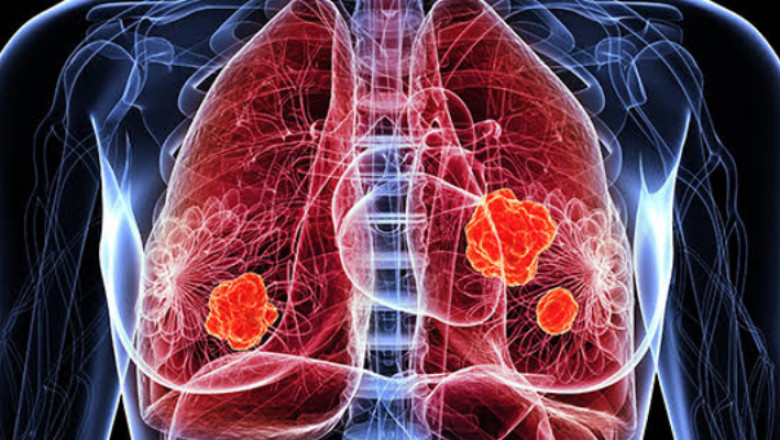 Breast Cancer Specialists in Mumbai: A Guide to Finding the Best Care