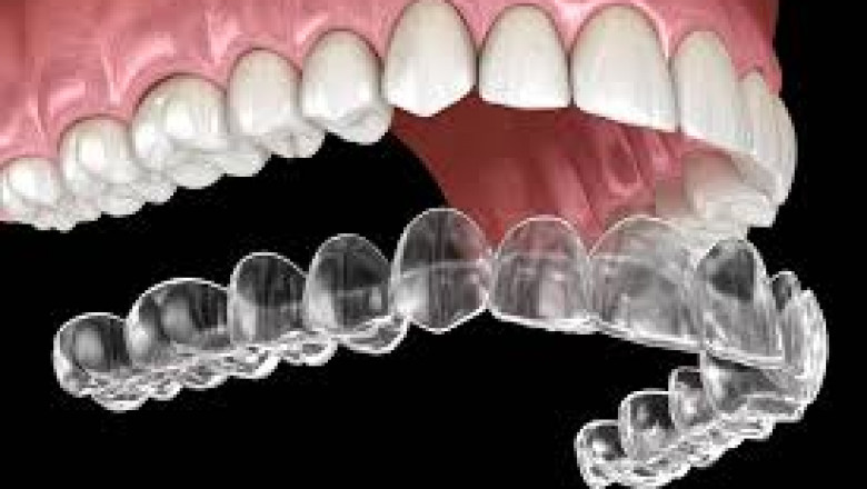 Invisalign Brampton