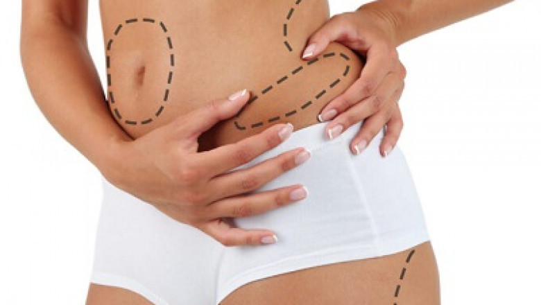 Liposuction Weight Loss: Precision Fat Removal for a Better You
