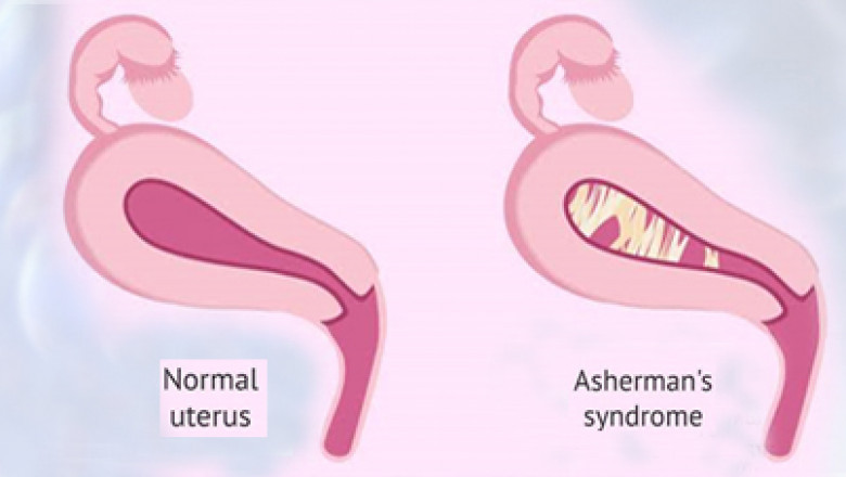 Ashermans Syndrome Market Growth Demand Statistics and Application Insights