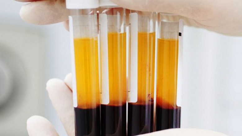 Platelet Rich Plasma Market Growth, Trends, and Strategic Insights 2025-2032