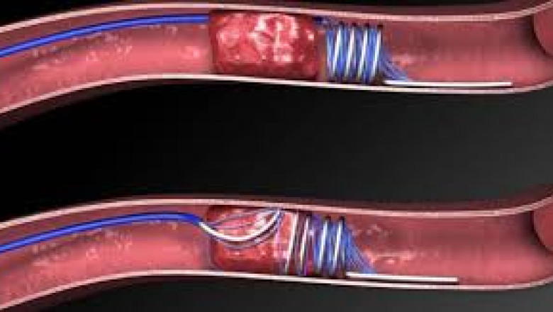 Thrombectomy Devices Market Size, Trends, and Growth Outlook 2025-2032