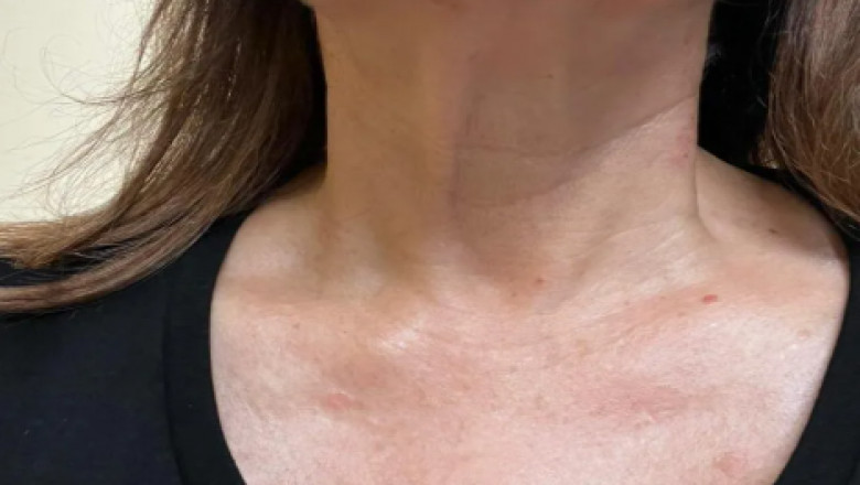 Why Double Chin Removal Los Angeles is Worth It : Best Methods