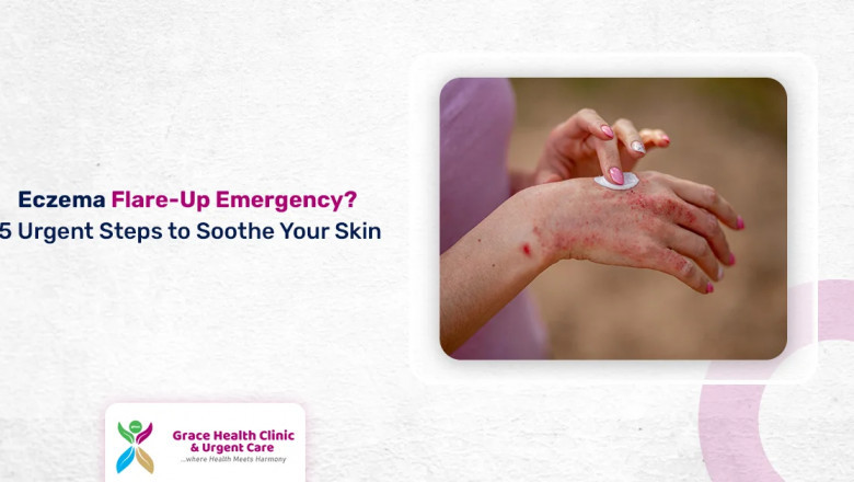 Eczema Flare-Up Emergency? 5 Urgent Steps to Calm and Soothe Your Skin