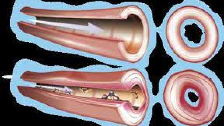 Emerging Demand in the Microscopic Polyangiitis Market Size: Share Insights from Hospital to Online Pharmacies