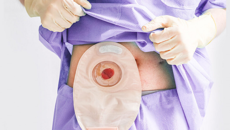 How to change your colostomy bag at home?