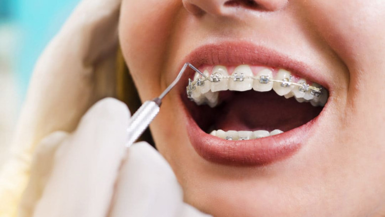 Top Braces Types You Can Get in Dubai