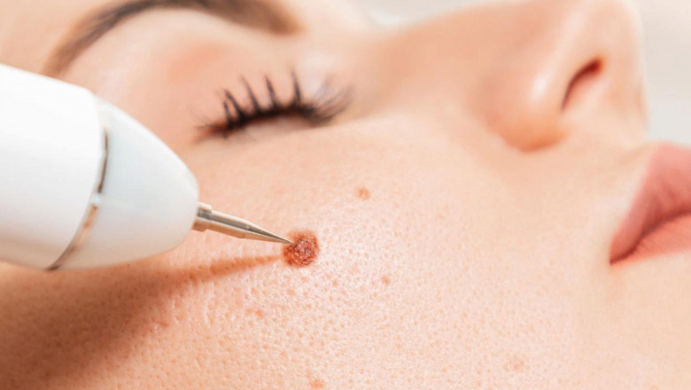 Wart Treatment for Women in Islamabad