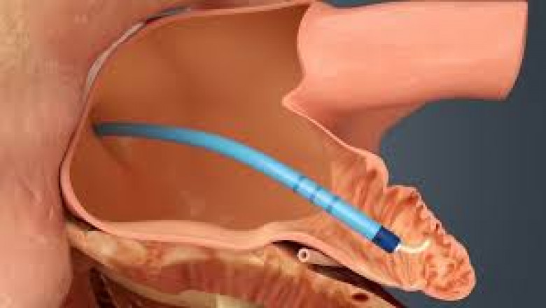 Atrial Fibrillation Device Market Intelligence: Key Insights Shaping Global Industry Growth